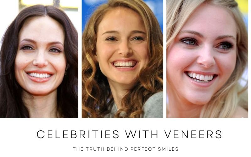 Celebrities with Veneers: The Truth Behind Perfect Smiles